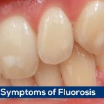 Fluorosis – Symptoms of Fluorosis