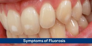 Read more about the article Fluorosis – Symptoms of Fluorosis