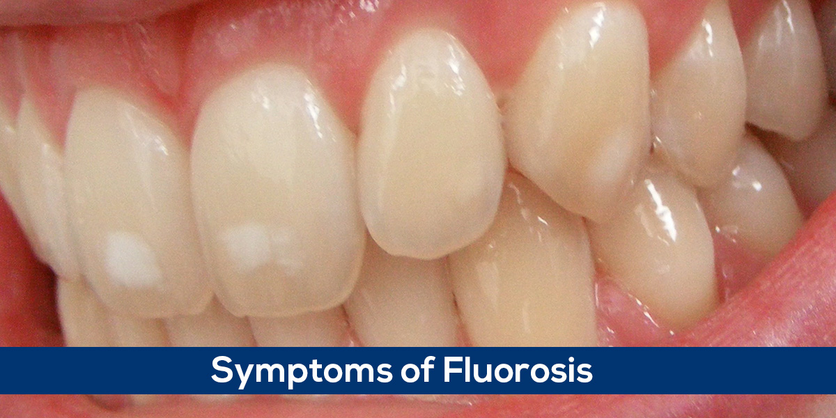 You are currently viewing Fluorosis – Symptoms of Fluorosis